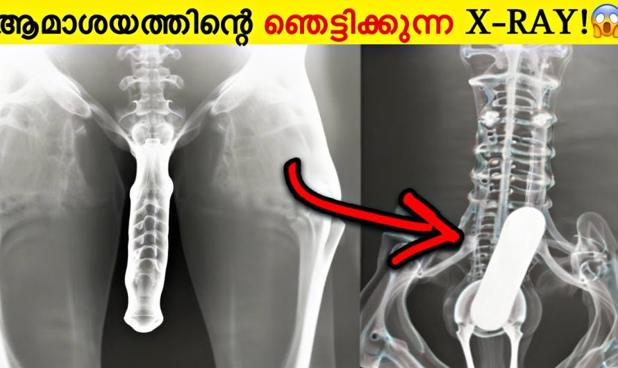 എക്സറെയിൽ കണ്ടെത്തിയ വളരെ അധികം വിചിത്രം  ആയിട്ടുള്ള കണ്ടെത്തലുകൾ 😱😱