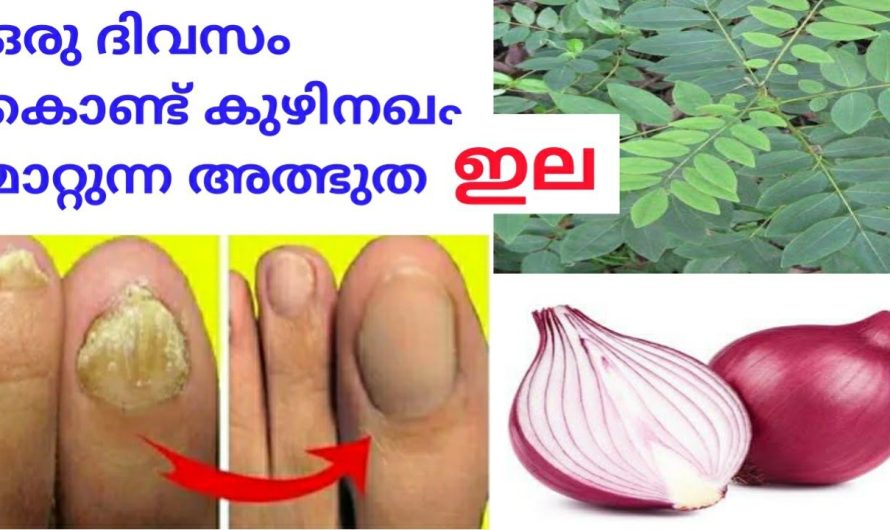 എത്ര പഴക്കം ചെന്ന കുഴി നഖവും ഒറ്റ യൂസിൽ മാറ്റാം