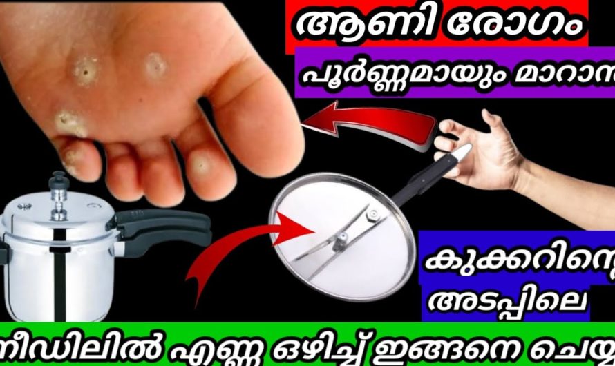 ആണിരോഗം ഉണ്ടോ?  അറിയാതെ പോയ രഹസ്യം