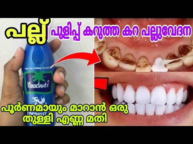 പല്ല്പുളിപ്പ് , കഠിനമായ പല്ലുവേദന, പല്ലിലെ കറ മാറാൻ ഒരു സ്പൂൺ എണ്ണ മതി