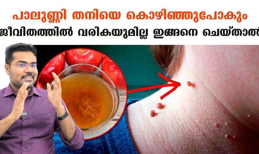 പാലുണ്ണി തനിയെ കൊഴിഞ്ഞുപോകും .പിന്നീട് ജീവിതത്തിൽ വരികയുമില്ല