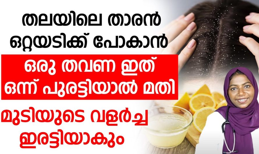 താരൻ ഒറ്റയടിക്ക് പോകാൻ ഒരു തവണ ഇത് ഒന്ന് പുരട്ടിയാൽ മതി